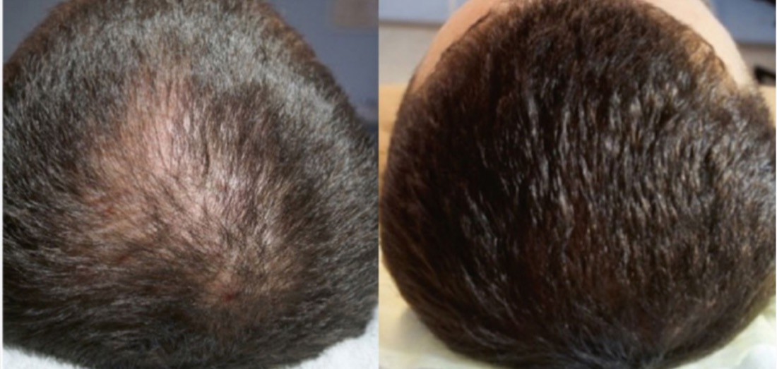 Hair loss treatment before and after — crown density improvement, HQ Med Spa Flushing Queens NY