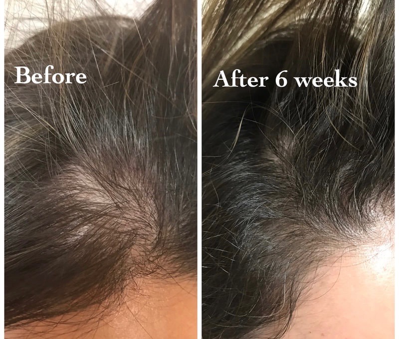Hair restoration before and after at HQ Med Spa in Flushing — thinning at the part filled in after 6 weeks